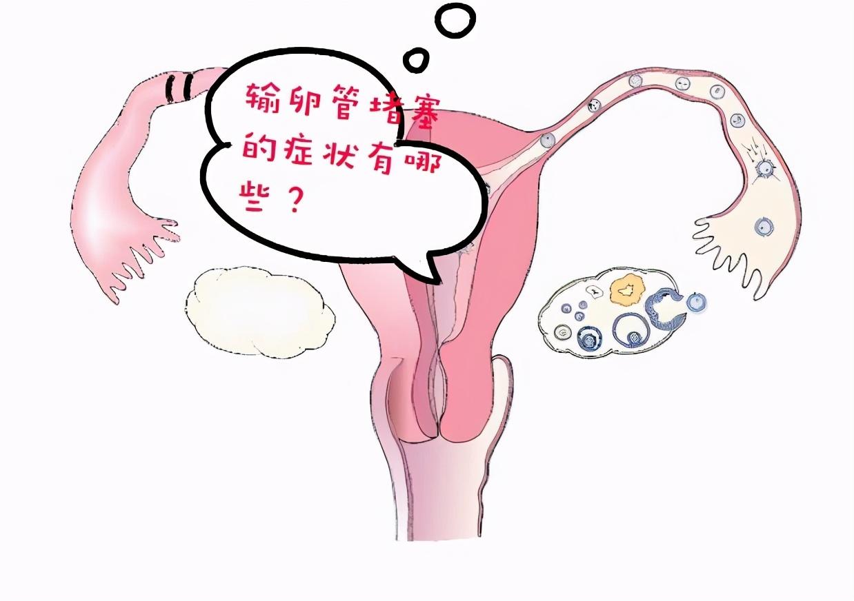 輸卵管堵塞的癥狀表現(xiàn)及其影響，輸卵管堵塞的癥狀、表現(xiàn)與影響探討