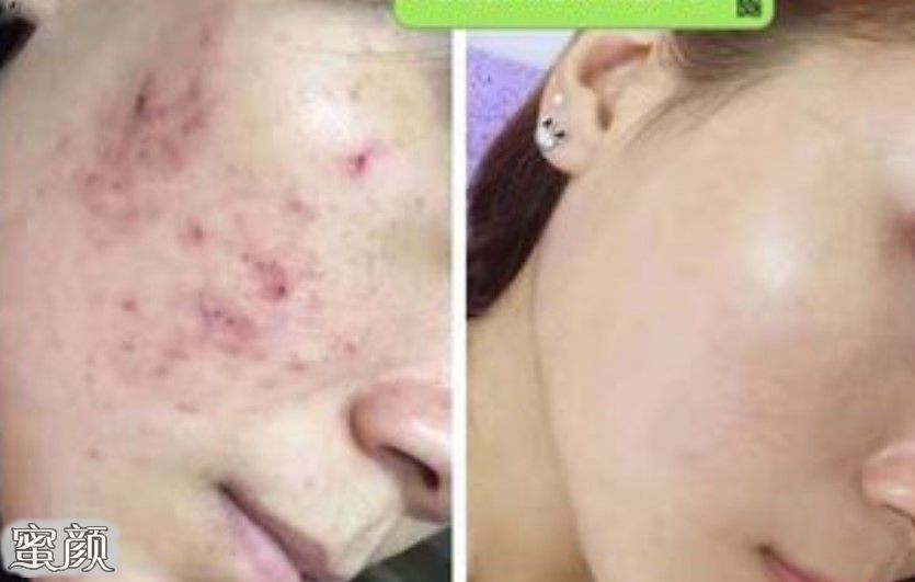 如何有效去除痘痘，全方位指南，全方位指南，如何有效去除痘痘