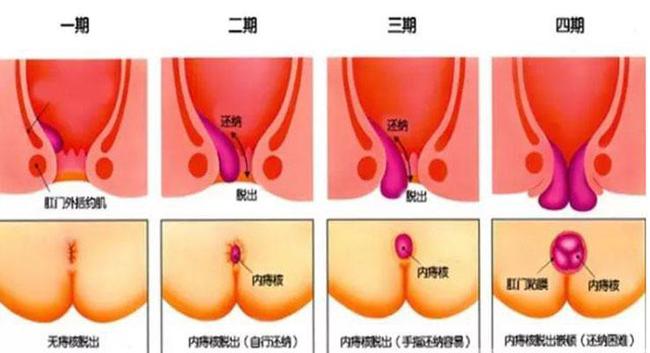 如何判斷自己是否得了痔瘡，癥狀、原因及預(yù)防策略，痔瘡判斷指南，癥狀、原因與預(yù)防策略全解析