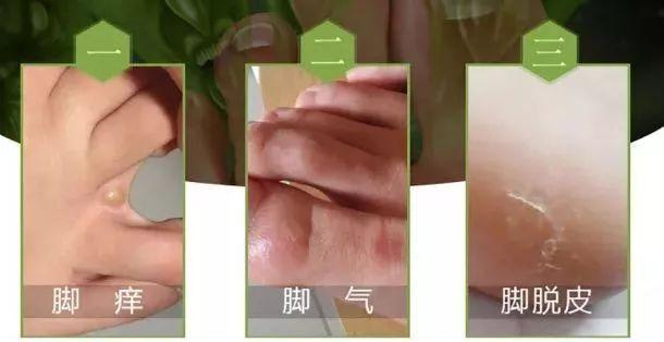 腳氣怎么治療能除根——全方位解析腳氣根除方法，全方位解析，腳氣根除方法與治療策略