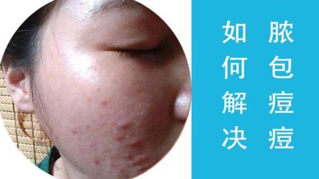 如何處理膿包痘痘，有效的解決方案和護(hù)理建議，膿包痘痘處理指南，有效解決方案與護(hù)理建議