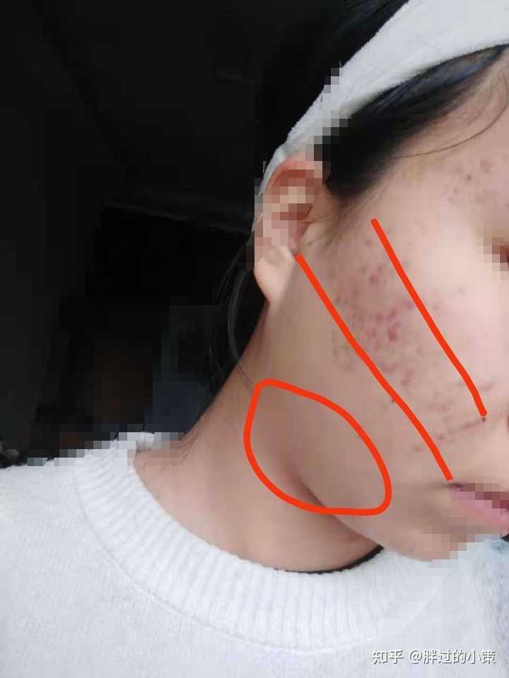 痘痘變成硬硬的鼓包怎么辦？專業(yè)指南助你輕松去除，痘痘變鼓包怎么辦？專業(yè)指南助你解決皮膚問(wèn)題