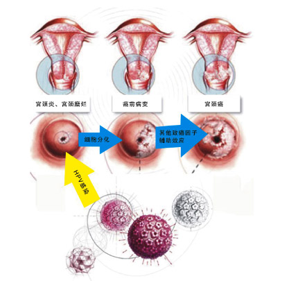 深入了解HPV，感染途徑與防范策略，HPV感染途徑、防范策略深度解析