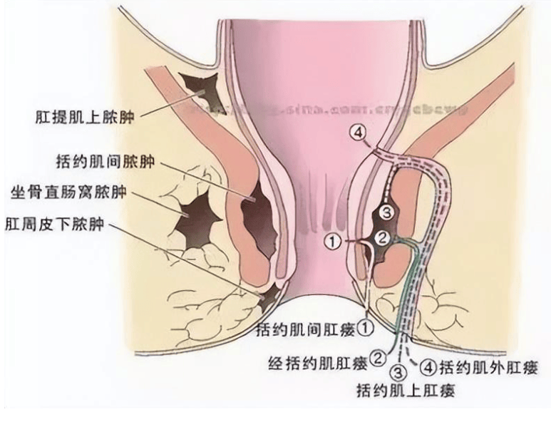 陽瘺會自己恢復(fù)嗎？——深入了解與治療建議，陽瘺能否自愈？深入了解與治療建議