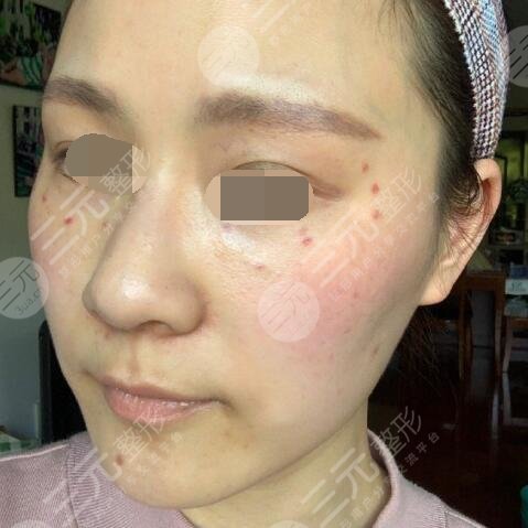 正規(guī)醫(yī)院激光祛斑多少錢？全面解析費(fèi)用因素，正規(guī)醫(yī)院激光祛斑費(fèi)用解析，多少錢？全面探討費(fèi)用因素