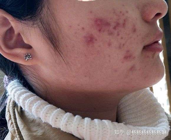 消除臉上痘痘的有效方法與策略，消除臉部痘痘的有效方法與策略