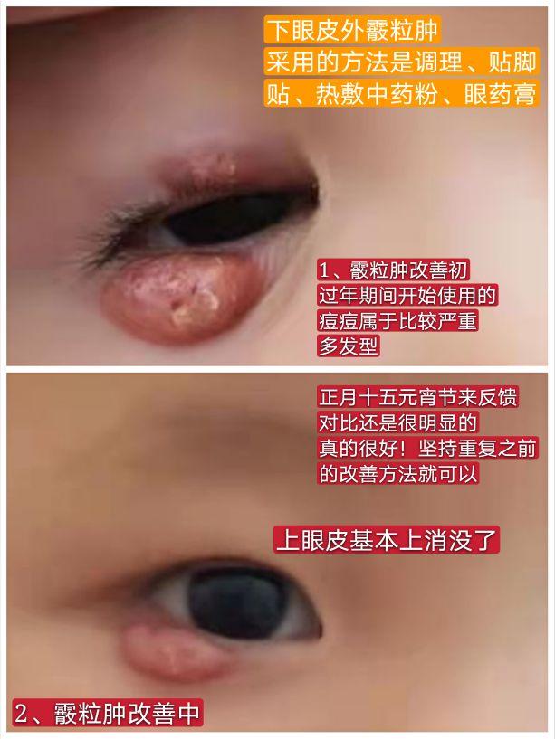 如何治療——全方位解析與指導(dǎo)，全方位解析與指導(dǎo)，治療方法詳解
