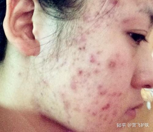 膿包痘痘處理方法，專業(yè)指南與日常護(hù)理建議，專業(yè)膿包痘痘處理方法及日常護(hù)理指南