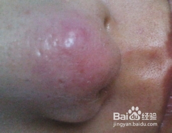 如何處理膿包痘痘——全面解析與有效應(yīng)對(duì)方案，全面解析應(yīng)對(duì)膿包痘痘的有效方案