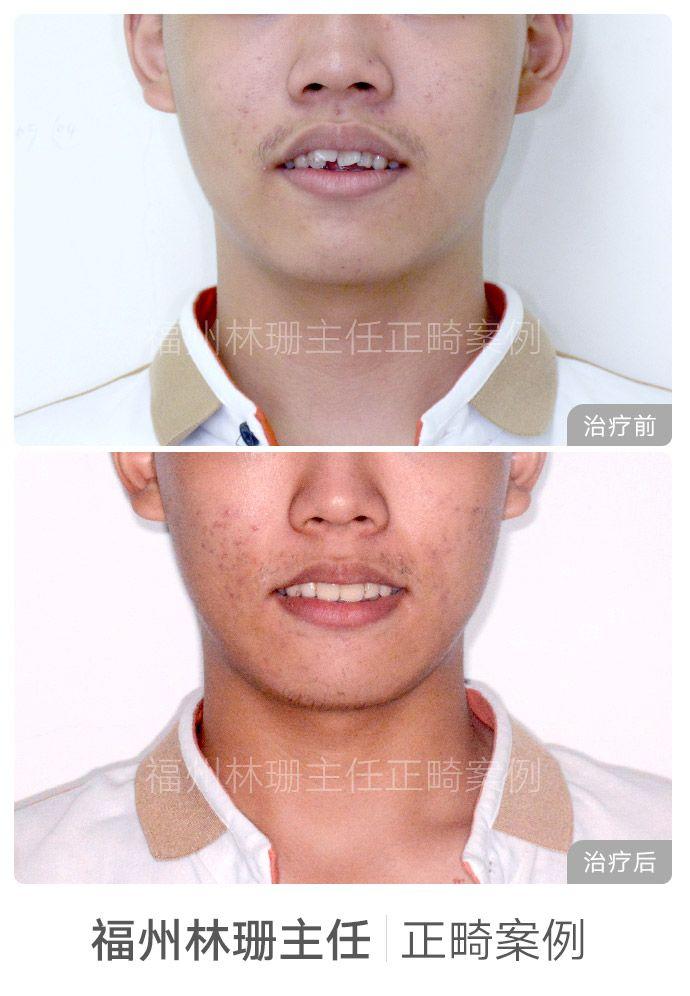 矯正牙齒大概多少錢(qián)——全面解析牙齒矯正費(fèi)用因素，矯正牙齒的費(fèi)用全面解析，牙齒矯正費(fèi)用因素探討