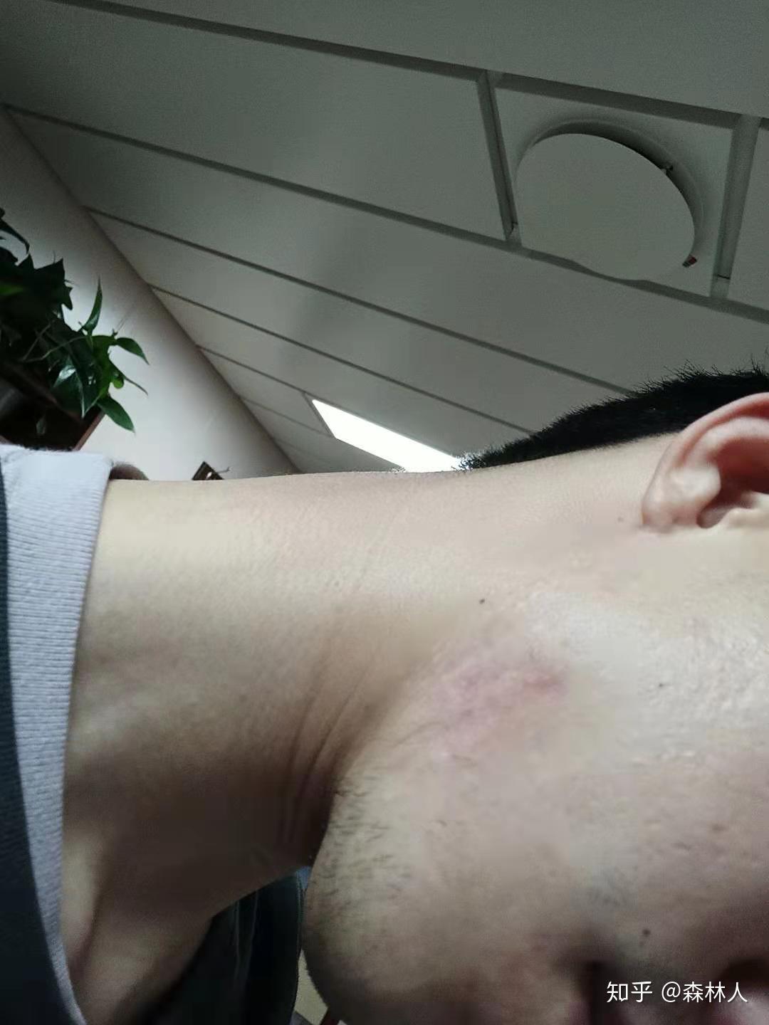 如何有效去除痤瘡留下的凸起疤痕疙瘩？，如何有效消除痤瘡后凸起疤痕疙瘩的方法
