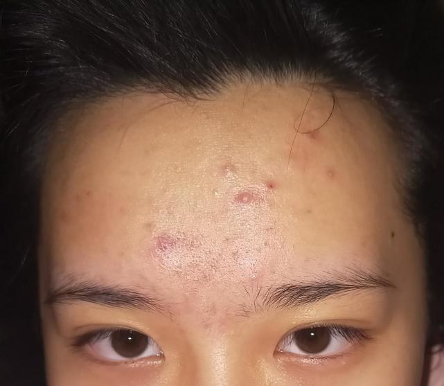 額頭長痘痘是什么原因引起的，額頭長痘痘的成因解析