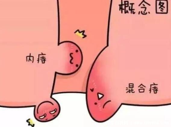 痔瘡肉球，一度、二度、三度的圖片解析與理解，痔瘡肉球，一度、二度、三度癥狀圖片解析及理解指南