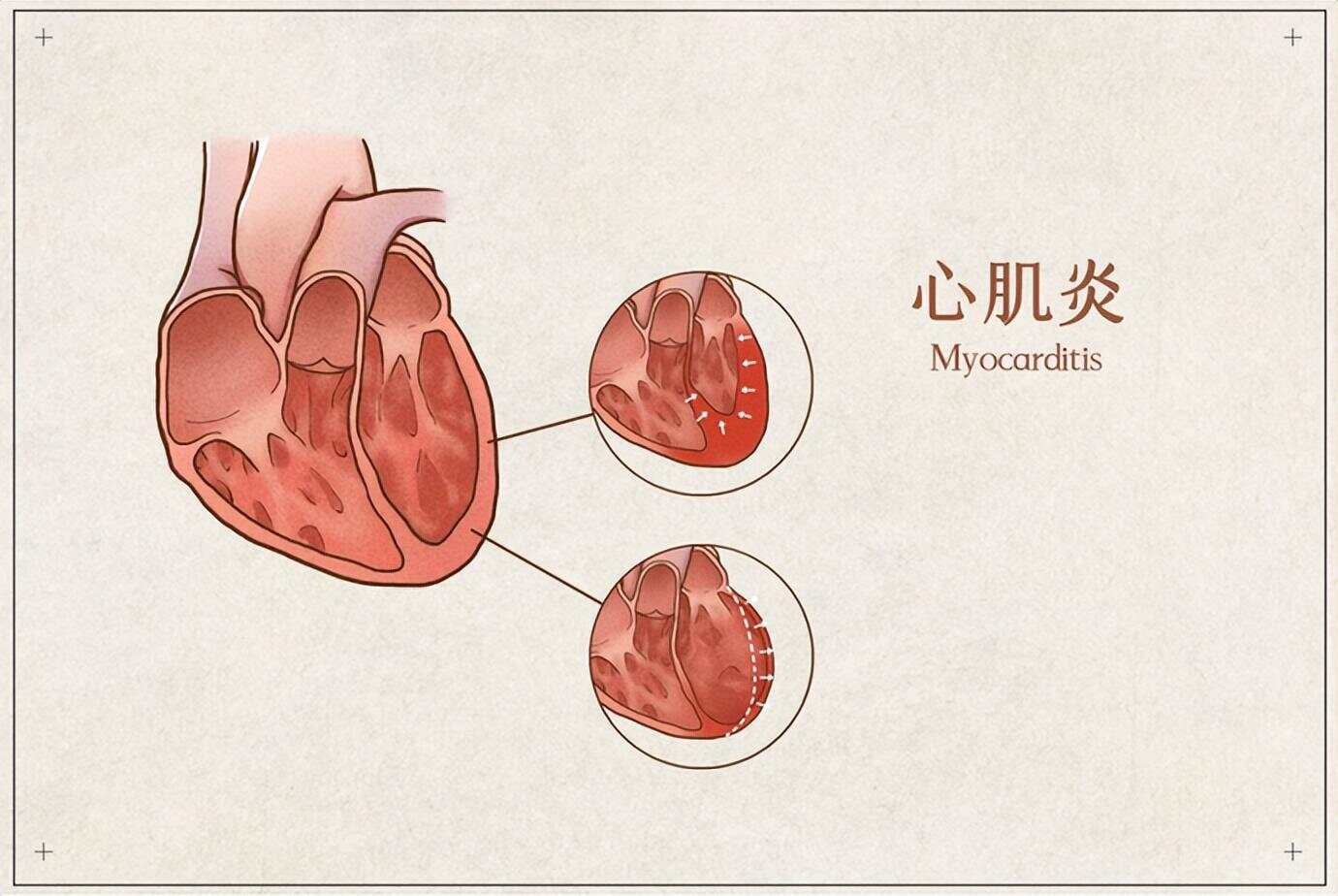 如何判斷自己是否得了心肌炎——癥狀與診斷方法解析，心肌炎的癥狀與診斷方法解析，如何判斷自身狀況？