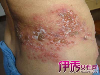 皰疹病毒怎么治療根除，全面理解與有效策略，皰疹病毒治療根除，全面理解與有效策略