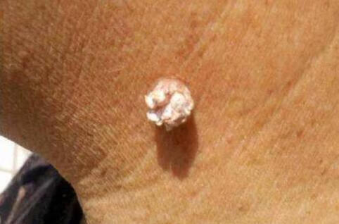 如何判斷下面長的是不是疣？全面解析與指南，全面解析指南，如何判斷下面長的是否為疣？