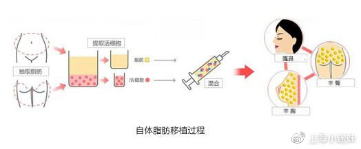 自體脂肪豐胸手術(shù)費(fèi)用詳解，大約需要多少錢？，自體脂肪豐胸手術(shù)費(fèi)用詳解，了解大約需要多少錢？