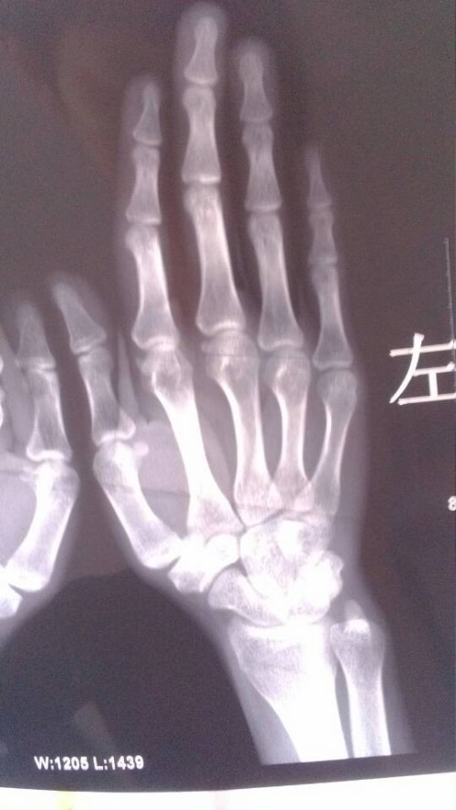 關(guān)于骨骼閉合的年齡，多少歲是骨骼閉合的一般時期？，骨骼閉合的一般時期年齡解析