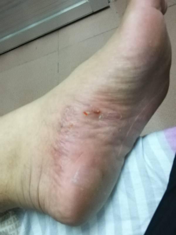 腳底長(zhǎng)了像水泡一樣的東西很癢，怎么回事？解讀腳部異常癥狀及其原因，腳部水泡狀突起，原因及解讀
