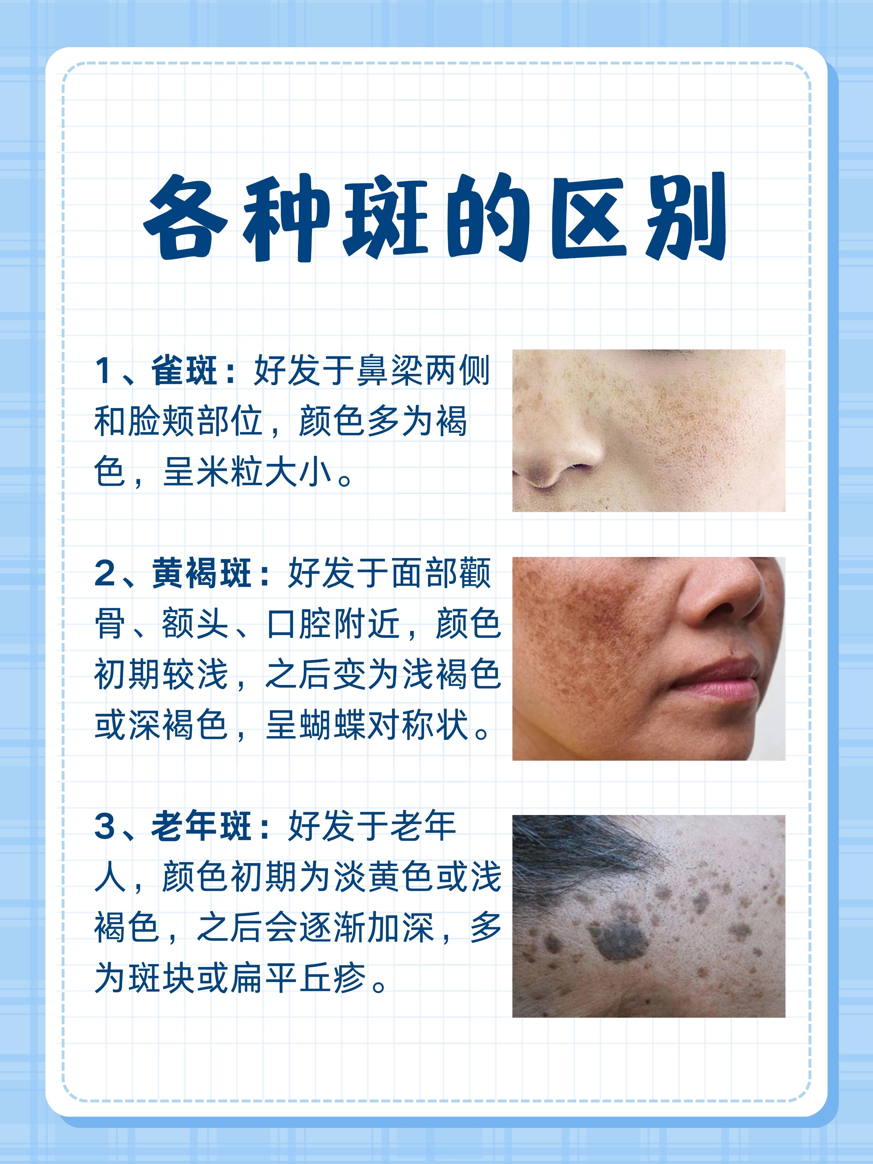 各種斑的區(qū)別圖解，深入了解不同斑點的特征，圖解各種斑的區(qū)別，深入了解不同斑點的特征與差異