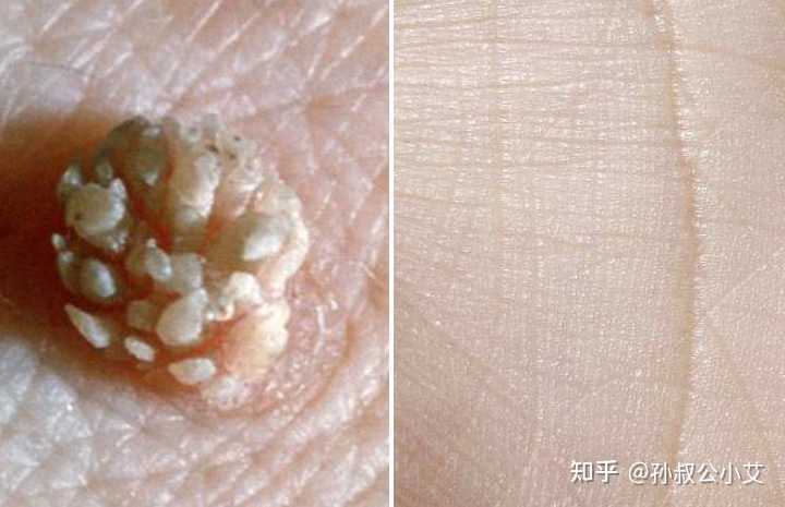 如何判斷皮膚上長(zhǎng)的是否為疣？全面解析與指導(dǎo)，全面解析指導(dǎo)，如何判斷皮膚上是否為疣？