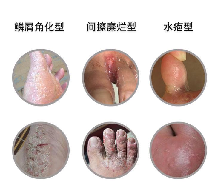 如何判斷是否為腳氣？全面解析腳氣癥狀與診斷方法，全面解析腳氣癥狀與診斷方法，如何判斷腳氣？