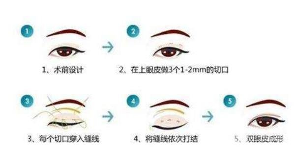 割雙眼皮多少錢——全面解析雙眼皮手術(shù)費(fèi)用因素，雙眼皮手術(shù)費(fèi)用全面解析，了解割雙眼皮的價(jià)格因素與費(fèi)用構(gòu)成