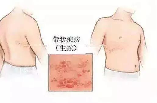 皰疹成因深度解析，皰疹生長的原因何在？，皰疹成因深度解析，探究皰疹生長的根本原因