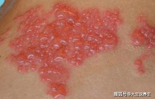 皰疹圖片，了解、識別與防治，皰疹圖片詳解，識別、防治全攻略