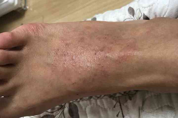腳上如何分辨是腳氣還是濕疹——一篇文章帶你了解兩者的區(qū)別，腳氣與濕疹的腳部癥狀解析，如何準(zhǔn)確分辨兩者的差異？