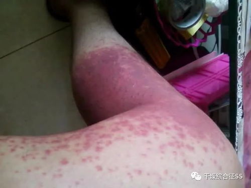 紅斑狼瘡圖片，了解病癥，科學(xué)應(yīng)對，紅斑狼瘡圖片詳解，科學(xué)認(rèn)識與應(yīng)對病癥