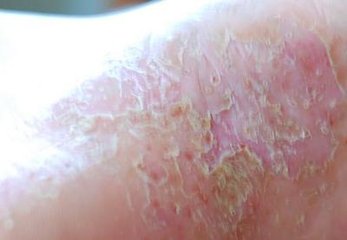 專治牛皮皮癬偏方，專治牛皮皮癬的偏方秘籍