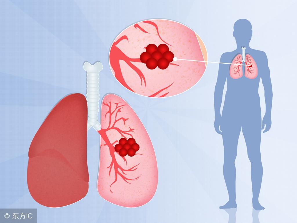 十個化療九個死是真的嗎？——深度解析化療的真相與誤區(qū)，深度解析，化療的真相與誤區(qū)——十個化療九個死說法探究