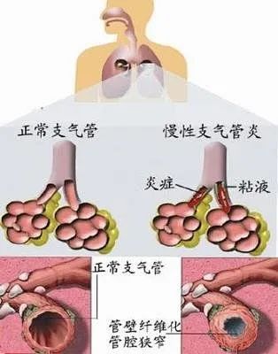 支氣管炎拖久了的后果，支氣管炎長期未治療的后果