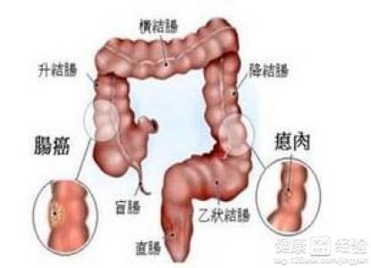 直腸癌的早期癥狀及其識別，直腸癌早期癥狀與識別方法