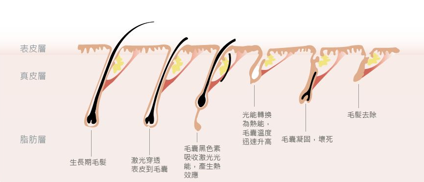 永久脫毛對身體有害嗎？全面解析脫毛方法與風險，全面解析永久脫毛方法與風險，對身體有害嗎？