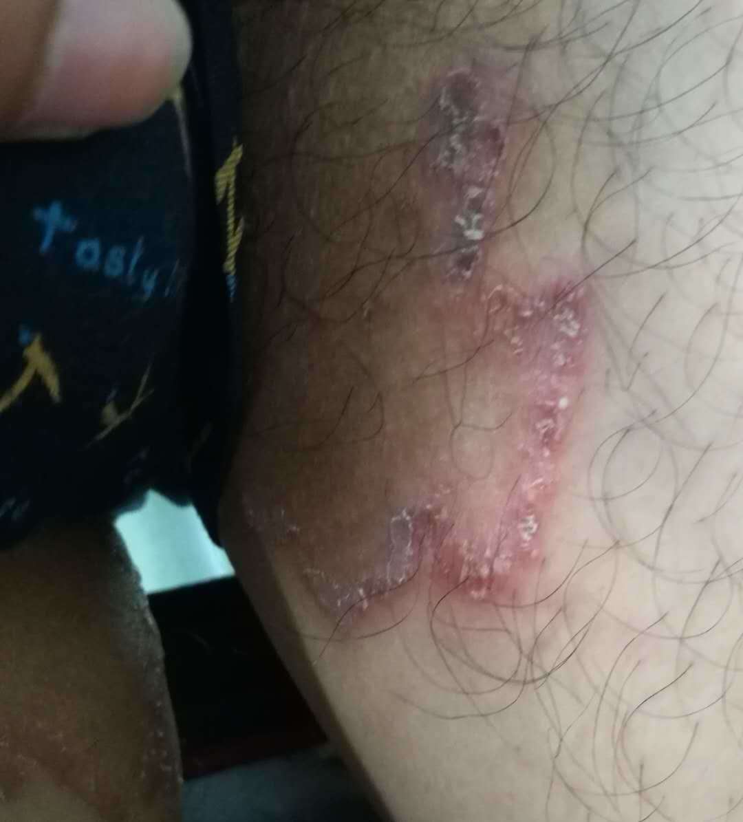 如何區(qū)分股癬與陰囊濕疹，癥狀、診斷與治療方法，股癬與陰囊濕疹，癥狀、診斷與治療方法詳解