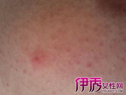 艾滋病初期皮疹圖片，了解、預(yù)防與應(yīng)對(duì)，艾滋病初期皮疹詳解，預(yù)防、應(yīng)對(duì)與知識(shí)普及