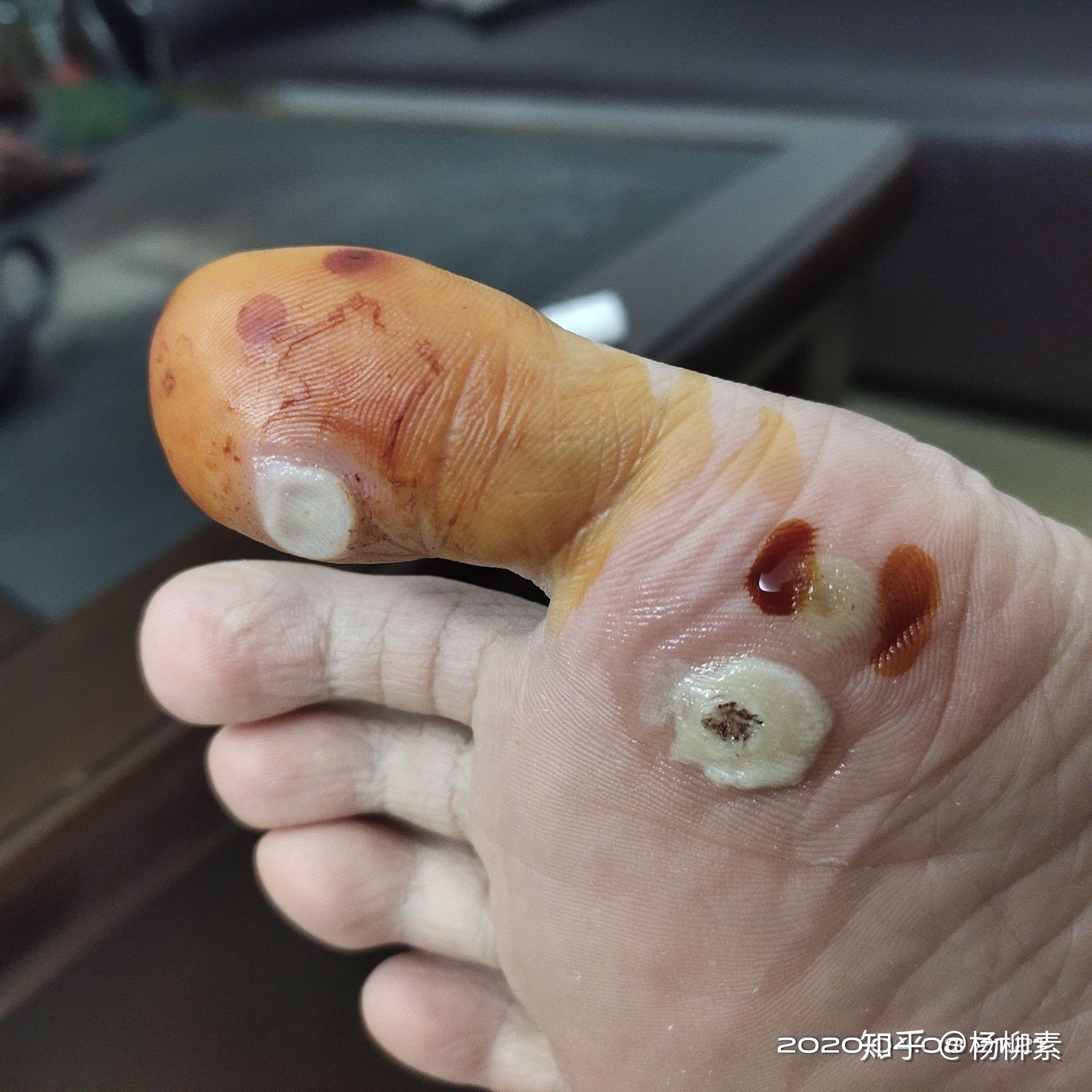 民間去疣最簡單最直接的方法，民間去疣最簡單直接的方法分享