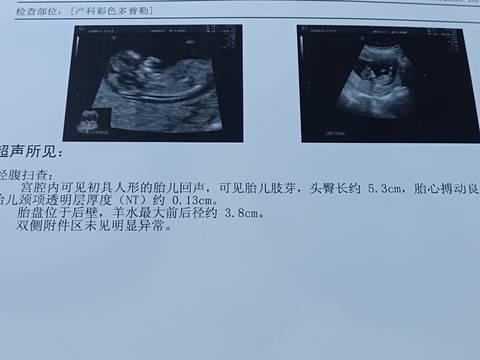 孕12周NT檢查，揭示胎兒性別的神秘面紗，孕12周NT檢查，揭開胎兒性別神秘面紗