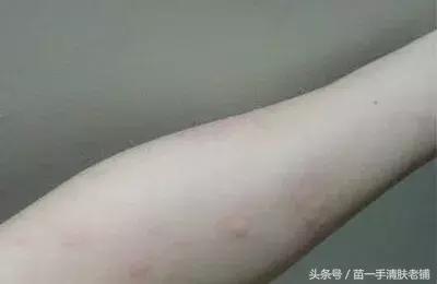 蕁麻疹一招永不復(fù)發(fā)——告別蕁麻疹的有效方法，告別蕁麻疹困擾，一招有效預(yù)防復(fù)發(fā)的方法