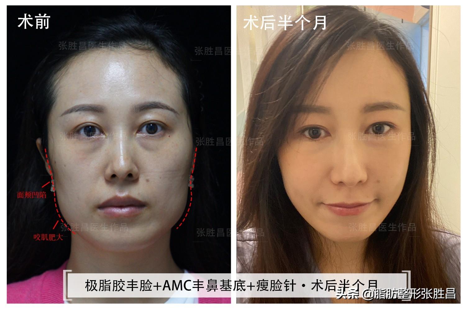 正規(guī)瘦臉針價格解析，多少錢一次？，正規(guī)瘦臉針價格詳解，一次需要多少錢？
