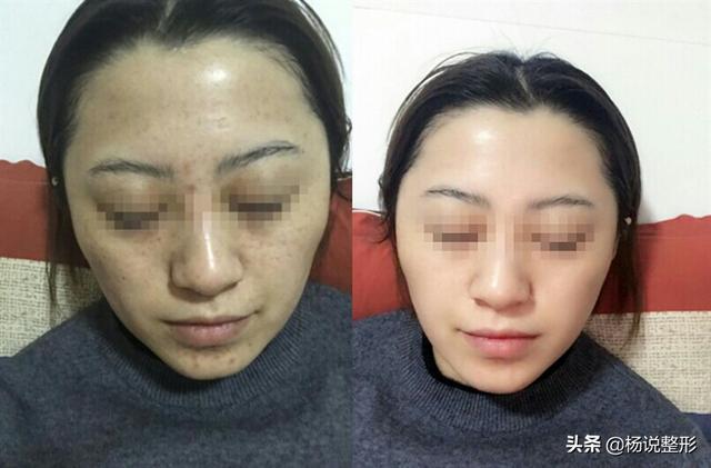 光子嫩膚前后對比照片，見證肌膚煥變的奇跡，光子嫩膚前后對比照，見證肌膚煥新奇跡