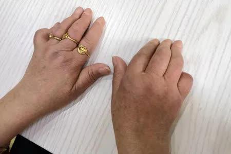 類風(fēng)濕關(guān)節(jié)炎治療的最佳方法，類風(fēng)濕關(guān)節(jié)炎的最佳治療方法探討