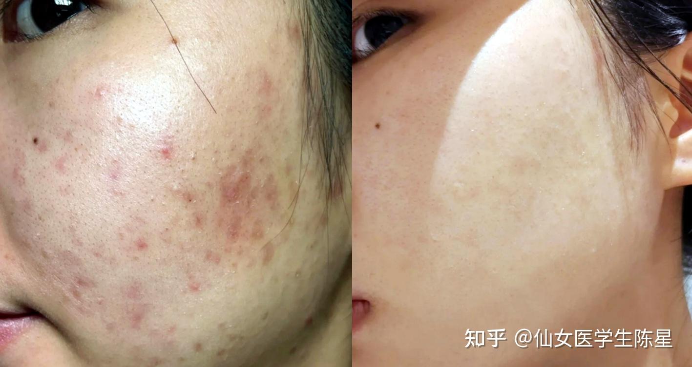 怎樣去除痘印，全面解析痘印消除方法與技巧，全面解析，如何有效去除痘印，痘印消除方法與技巧指南