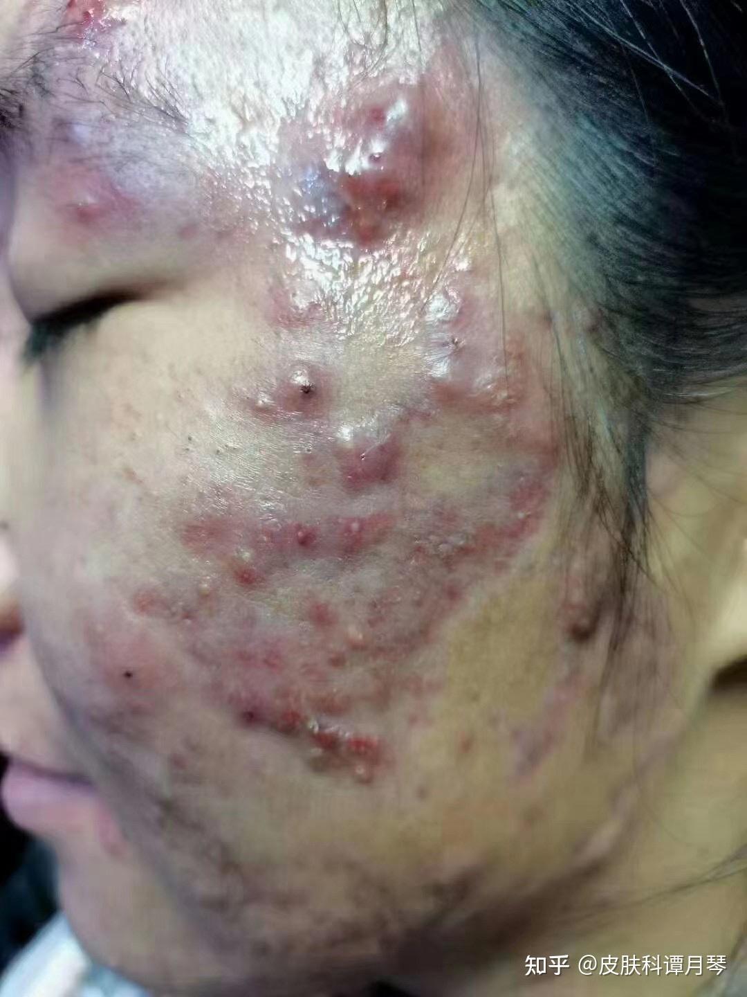 膿包型痤瘡，成因、治療與預(yù)防的全面解析，全面解析膿包型痤瘡，成因、治療與預(yù)防策略