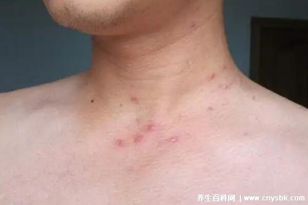 關于艾滋病小紅點特征圖的深度解析，艾滋病小紅點特征圖深度解析與識別指南