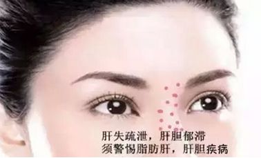肝氣郁結型黃褐斑圖片，深入了解與防治策略，肝氣郁結型黃褐斑詳解，圖片展示與防治策略