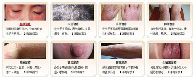 濕疹最佳治療方法，全方位解析與個(gè)性化護(hù)理策略，全方位解析濕疹最佳治療方法與個(gè)性化護(hù)理策略