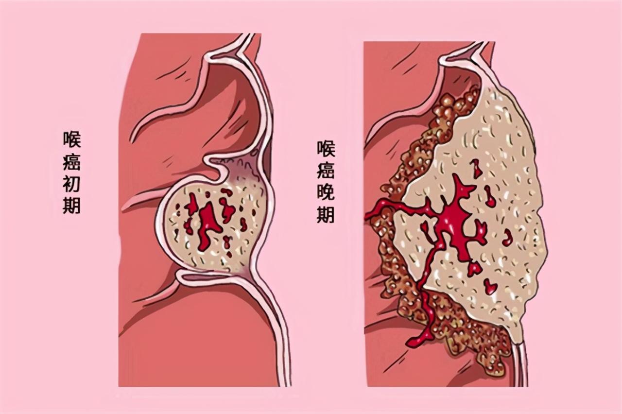 如何自己排除喉癌的風(fēng)險(xiǎn)，預(yù)防與早期發(fā)現(xiàn)的方法，喉癌預(yù)防與早期發(fā)現(xiàn)策略，降低風(fēng)險(xiǎn)，守護(hù)咽喉健康